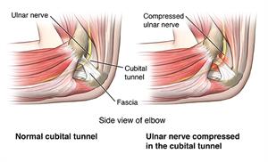 elbow pain, cubital tunnel syndrome