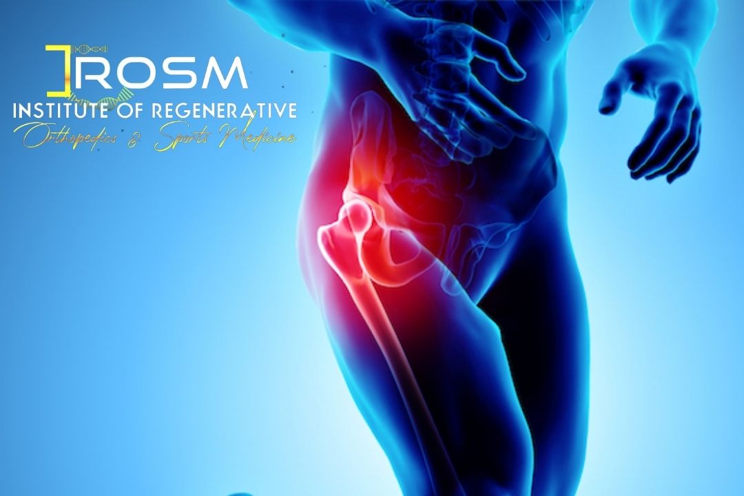 Prp Therapy For Hip Osteoarthritis In Fort Lauderdale Fl Irosm