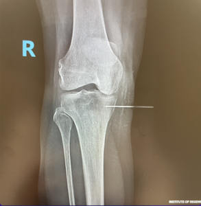 IntraOsseous injection with PRP and stem cells for joint pain, Modern Treatment for Advanced Osteoarthritis