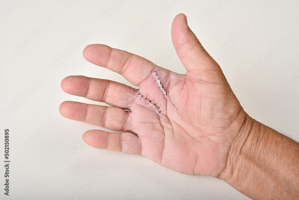 trigger finger surgery, trigger finger release procedure