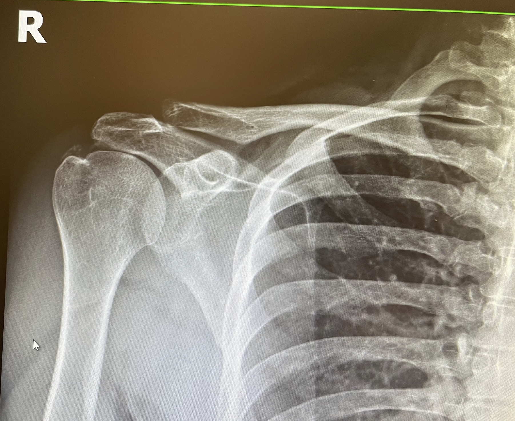 SI Joint Pain Treatment with Dr. Michael Erdman at IROSM in Fort Lauderdale