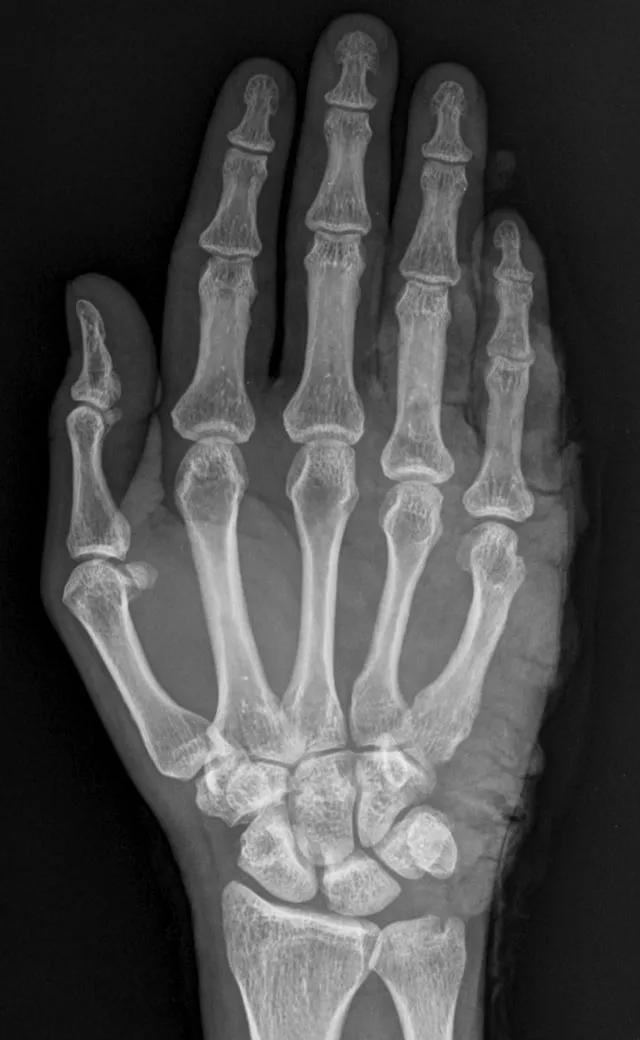 Finger Dislocation Treatment at IROSM Fort Lauderdale