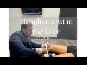 Ganglion cyst in the knee explained by Dr. Jorge Gonzalez, IROSM Fort Lauderdale