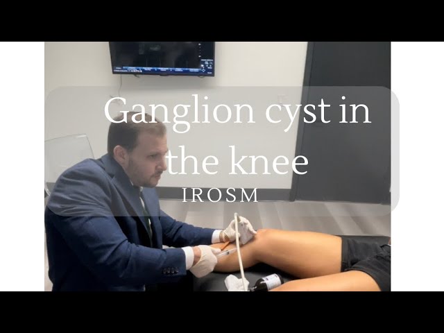 Ganglion cyst in the knee explained by Dr. Jorge Gonzalez, IROSM Fort Lauderdale