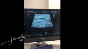 Tennis leg calf muscle tear ultrasound diagnosis, IROSM Fort Lauderdale
